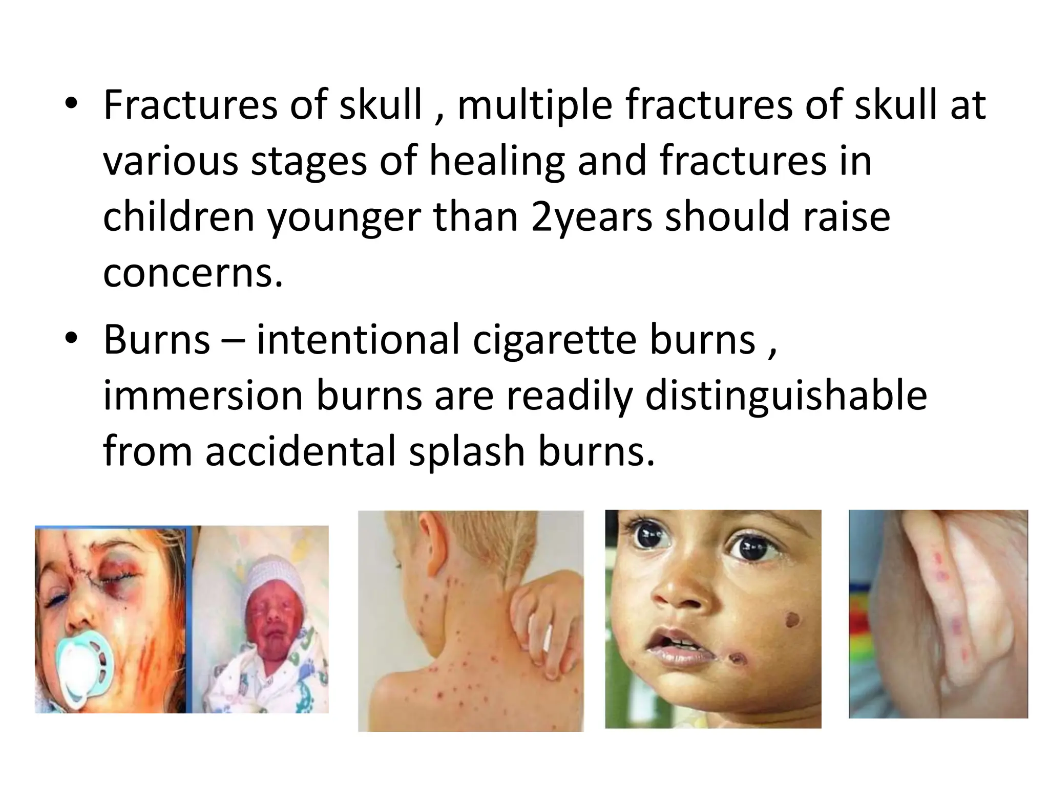 • Fractures of skull , multiple fractures of skull at
various stages of healing and fractures in
children younger than 2years should raise
concerns.
• Burns – intentional cigarette burns ,
immersion burns are readily distinguishable
from accidental splash burns.
 