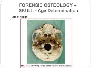 FORENSIC OSTEOLOGY –
SKULL - Age Determination
.
Secondary Changes in Skull
• Texture – (after Todd 1939 and Cobb 1952) th...