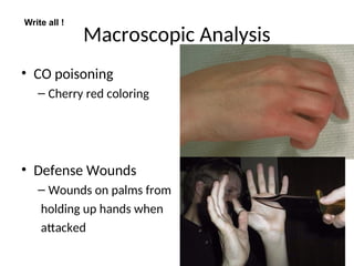 Macroscopic Analysis
• CO poisoning
– Cherry red coloring
• Defense Wounds
– Wounds on palms from
holding up hands when
attacked
Write all !
 