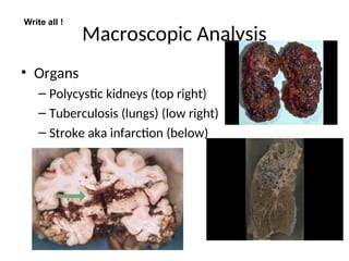 Macroscopic Analysis
• Organs
– Polycystic kidneys (top right)
– Tuberculosis (lungs) (low right)
– Stroke aka infarction (below)
Write all !
 