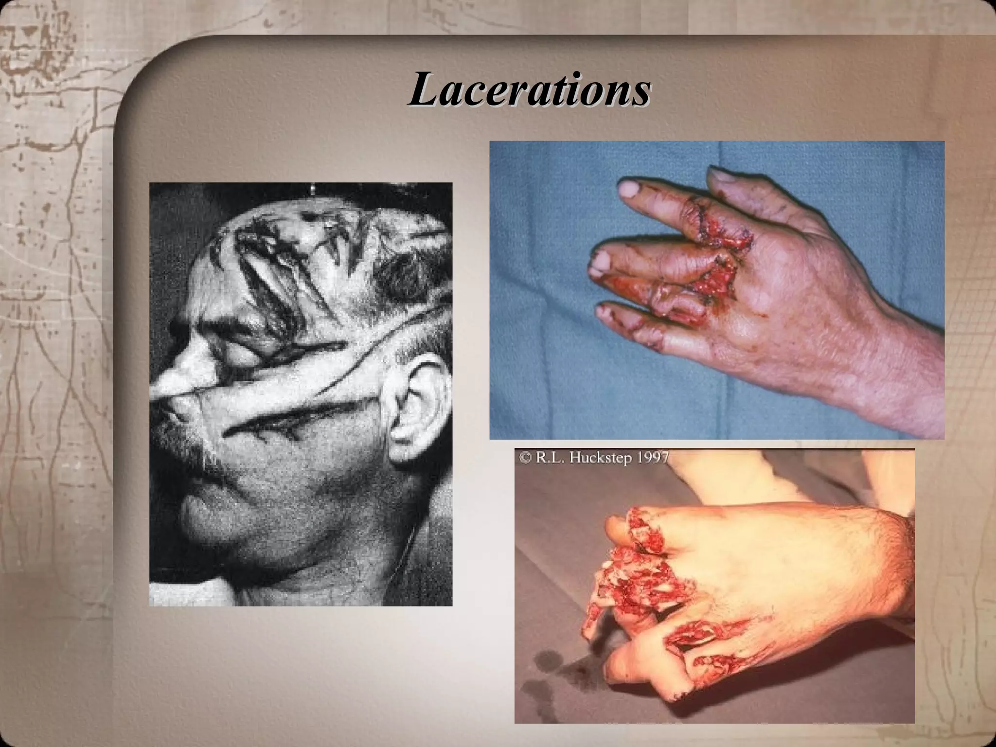 LacerationsLacerations
 