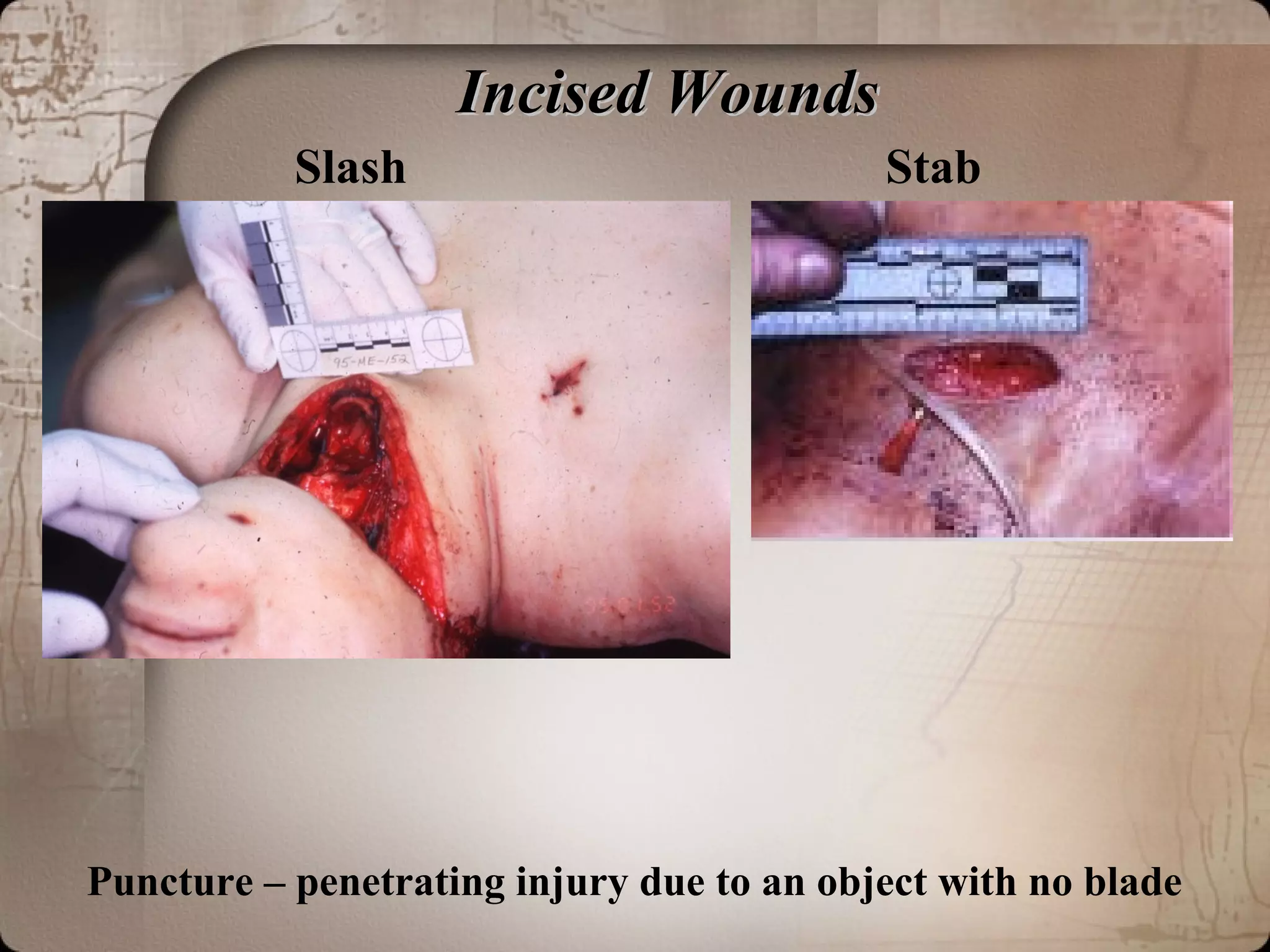 Incised WoundsIncised Wounds
Slash Stab
Puncture – penetrating injury due to an object with no blade
 