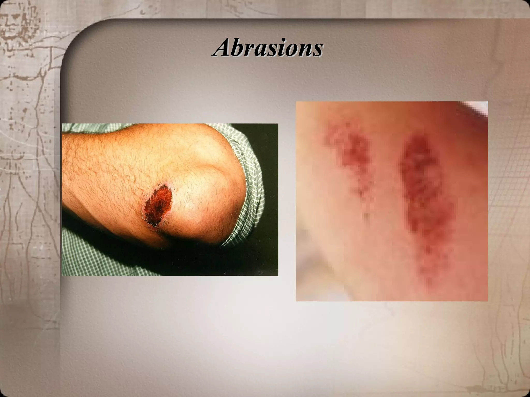 AbrasionsAbrasions
 