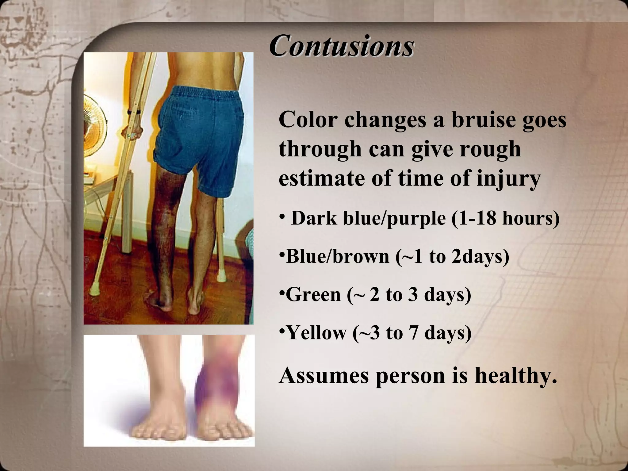 ContusionsContusions
Color changes a bruise goes
through can give rough
estimate of time of injury
• Dark blue/purple (1-18 hours)
•Blue/brown (~1 to 2days)
•Green (~ 2 to 3 days)
•Yellow (~3 to 7 days)
Assumes person is healthy.
 