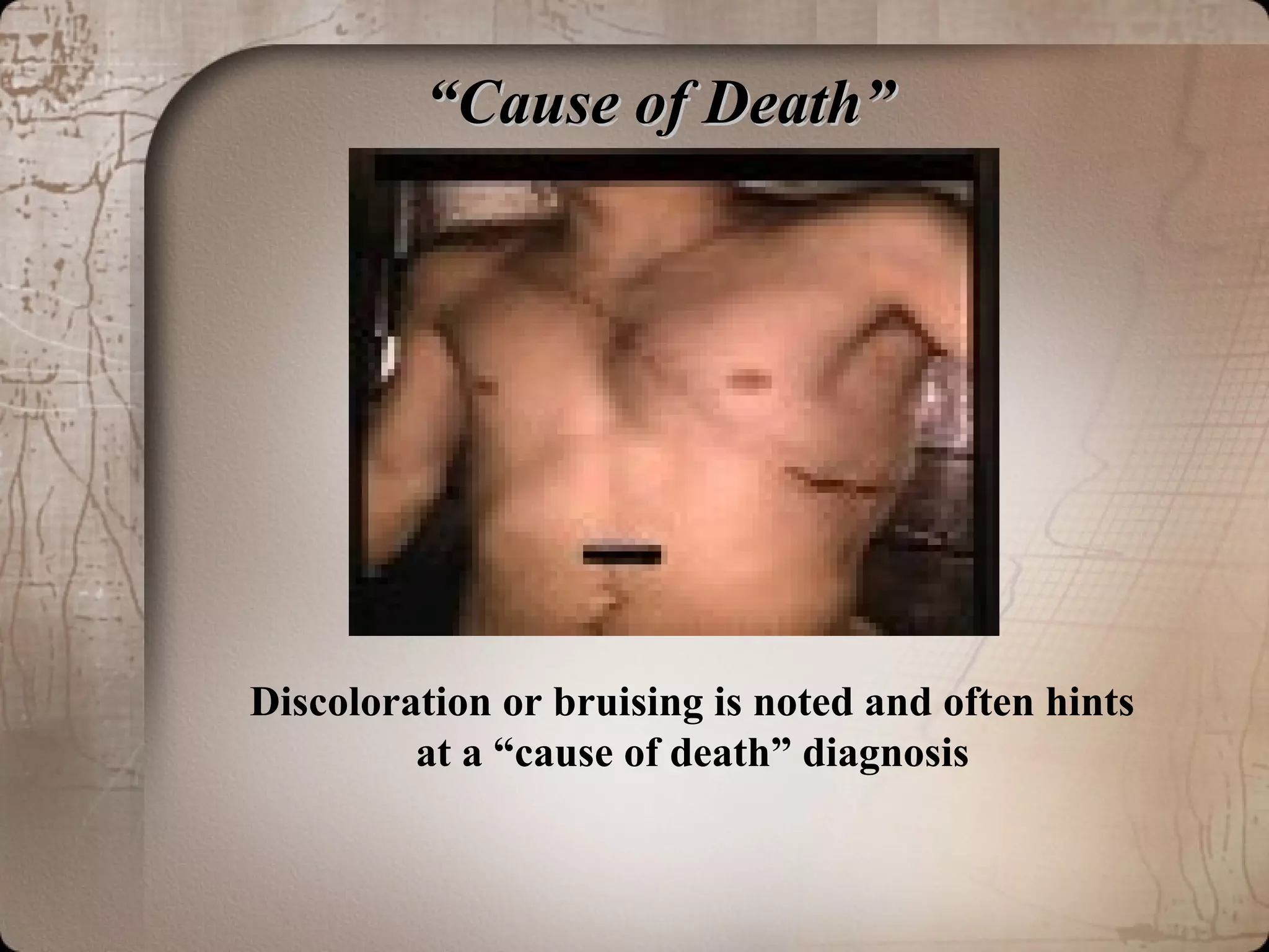““Cause of Death”Cause of Death”
Discoloration or bruising is noted and often hints
at a “cause of death” diagnosis
 