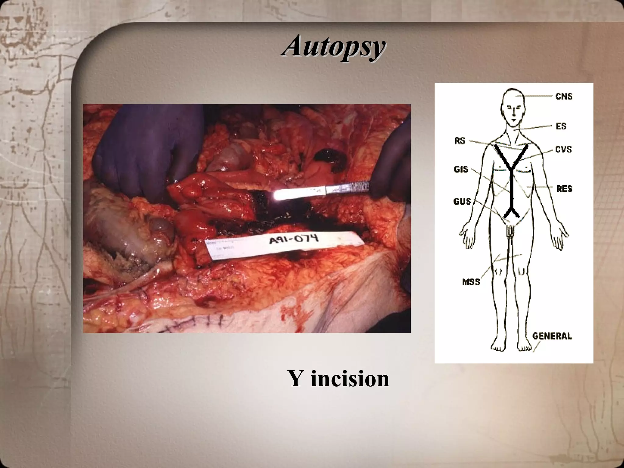 AutopsyAutopsy
Y incision
 