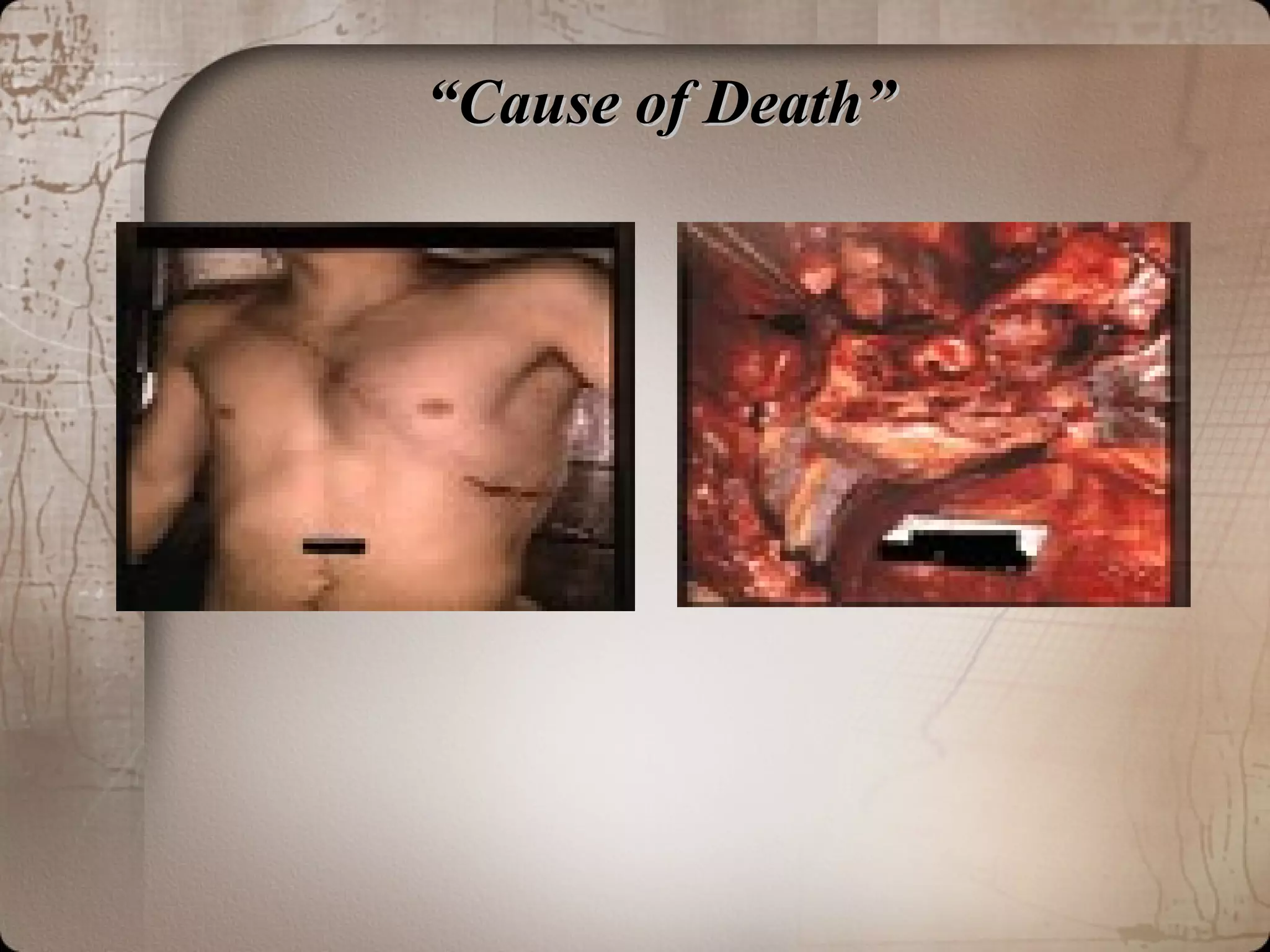 ““Cause of Death”Cause of Death”
 