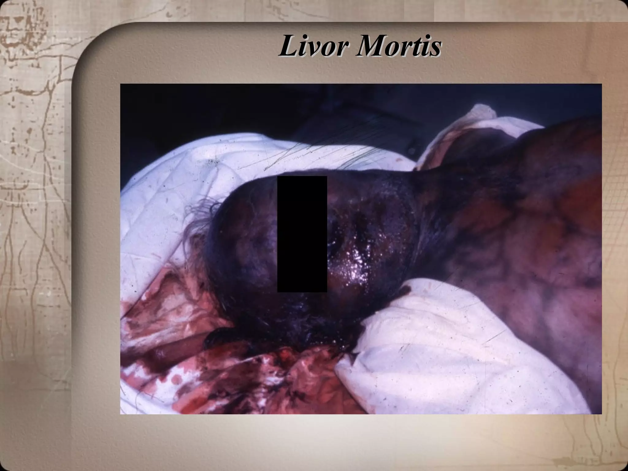 Livor MortisLivor Mortis
 