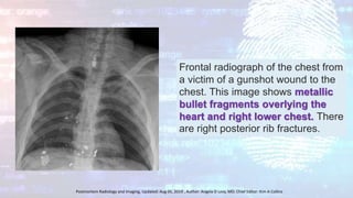Frontal radiograph of the chest from
a victim of a gunshot wound to the
chest. This image shows metallic
bullet fragments overlying the
heart and right lower chest. There
are right posterior rib fractures.
Postmortem Radiology and Imaging, Updated: Aug 05, 2019 , Author: Angela D Levy, MD; Chief Editor: Kim A Collins
 