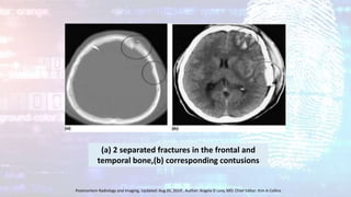 (a) 2 separated fractures in the frontal and
temporal bone,(b) corresponding contusions
Postmortem Radiology and Imaging, Updated: Aug 05, 2019 , Author: Angela D Levy, MD; Chief Editor: Kim A Collins
 