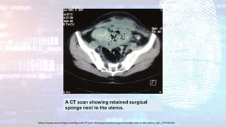 A CT scan showing retained surgical
sponge next to the uterus.
https://www.researchgate.net/figure/A-CT-scan-showing-retained-surgical-sponge-next-to-the-uterus_fig1_257536156
 