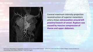 Coronal maximum intensity-projection
reconstruction of superior mesenteric
artery shows extravasation around left
proximal branch of vessel. Rupture was
caused by massive compression of
thorax and upper abdomen.
Postmortem Whole-Body CT Angiography: Evaluation of Two Contrast Media Solutions. Steffen Ross, Danny Spendlove1 Stephan Bolliger1 Andreas Christe2 Lars
Oesterhelweg1 Silke Grabherr3 Michael J. Thali1 Erich Gygax4
 
