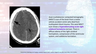 Axial multidetector computed tomography
(MDCT) scan of the brain from a motor
vehicle accident victim who died from
multisystem blunt trauma. This axial MDCT
scan shows a hyperattenuating acute right
subdural hematoma (arrow). There is
diffuse edema of the right cerebral
hemisphere, compression of the ventricular
system, and subfalcine herniation.
Postmortem Radiology and Imaging, Updated: Aug 05, 2019 , Author: Angela D Levy, MD; Chief Editor: Kim A Collins
 