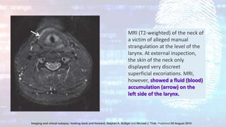 MRI (T2-weighted) of the neck of
a victim of alleged manual
strangulation at the level of the
larynx. At external inspection,
the skin of the neck only
displayed very discreet
superficial excoriations. MRI,
however, showed a fluid (blood)
accumulation (arrow) on the
left side of the larynx.
Imaging and virtual autopsy: looking back and forward, Stephan A. Bolliger and Michael J. Thali, Published:05 August 2015
 