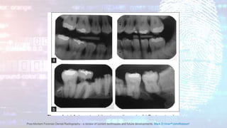 Post-Mortem Forensic Dental Radiography - a review of current techniques and future developments, Mark D.VinerabJohnRobsonc
 