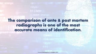 The comparison of ante & post mortem
radiographs is one of the most
accurate means of identification.
Forensic Radiology by B. G. Brogdon, M.D
 