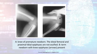 A: knee of premature newborn. The distal femoral and
proximal tibial epiphyses are not ossified. B: term
newborn with knee epiphyses (arrows) present
Forensic Radiology by B. G. Brogdon, M.D
 