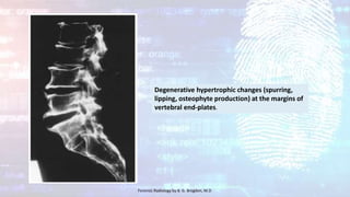 Degenerative hypertrophic changes (spurring,
lipping, osteophyte production) at the margins of
vertebral end-plates.
Forensic Radiology by B. G. Brogdon, M.D
 