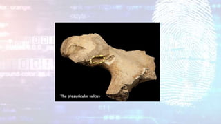 The preauricular sulcus
 
