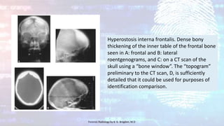 Hyperostosis interna frontalis. Dense bony
thickening of the inner table of the frontal bone
seen in A: frontal and B: lateral
roentgenograms, and C: on a CT scan of the
skull using a “bone window”. The “topogram”
preliminary to the CT scan, D, is sufficiently
detailed that it could be used for purposes of
identification comparison.
Forensic Radiology by B. G. Brogdon, M.D
 