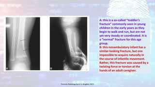 A: this is a so-called “toddler’s
fracture” commonly seen in young
children in the early years as they
begin to walk and run, but are not
yet very steady or coordinated. It is
a “normal” fracture for this age
group.
B: this nonambulatory infant has a
similar-looking fracture, but one
impossible to acquire naturally in
the course of infantile movement.
Rather, this fracture was caused by a
twisting force or torsion at the
hands of an adult caregiver.
Forensic Radiology by B. G. Brogdon, M.D
 