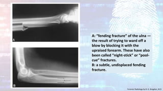 A: “fending fracture” of the ulna —
the result of trying to ward off a
blow by blocking it with the
upraised forearm. These have also
been called “night-stick” or “pool-
cue” fractures.
B: a subtle, undisplaced fending
fracture.
Forensic Radiology by B. G. Brogdon, M.D
 