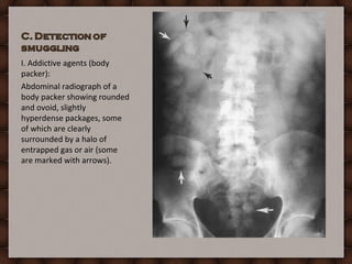 Forensic radiology practical under | PPT