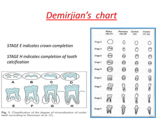 Demirjian’s chart
103
STAGE E indicates crown completion
STAGE H indicates completion of tooth
calcification
 
