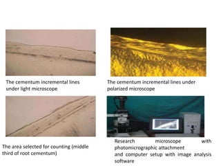 The cementum incremental lines
under light microscope
The cementum incremental lines under
polarized microscope
The area selected for counting (middle
third of root cementum)
Research microscope with
photomicrographic attachment
and computer setup with image analysis
software
 