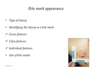 8/30/2018 127
Bite mark appearance
• Type of injury
• Identifying the injury as a bite mark
 Gross features
 Class features
 Individual features
• Site of bite marks
 