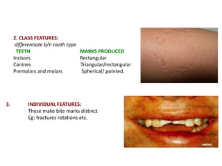 3. INDIVIDUAL FEATURES:
These make bite marks distinct
Eg: fractures rotations etc.
2. CLASS FEATURES:
differentiate b/n tooth type
TEETH MARKS PRODUCED
Incisors Rectangular
Canines Triangular/rectangular
Premolars and molars Spherical/ pointed.
 