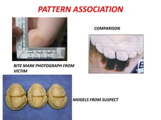 PATTERN ASSOCIATION
BITE MARK PHOTOGRAPH FROM
VICTIM
COMPARISON
MODELS FROM SUSPECT
 