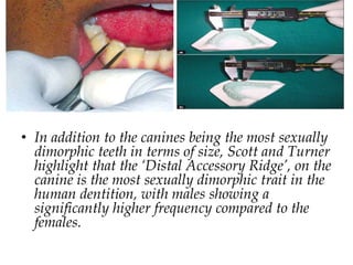 • In addition to the canines being the most sexually
dimorphic teeth in terms of size, Scott and Turner
highlight that the ‘Distal Accessory Ridge’, on the
canine is the most sexually dimorphic trait in the
human dentition, with males showing a
significantly higher frequency compared to the
females.
 