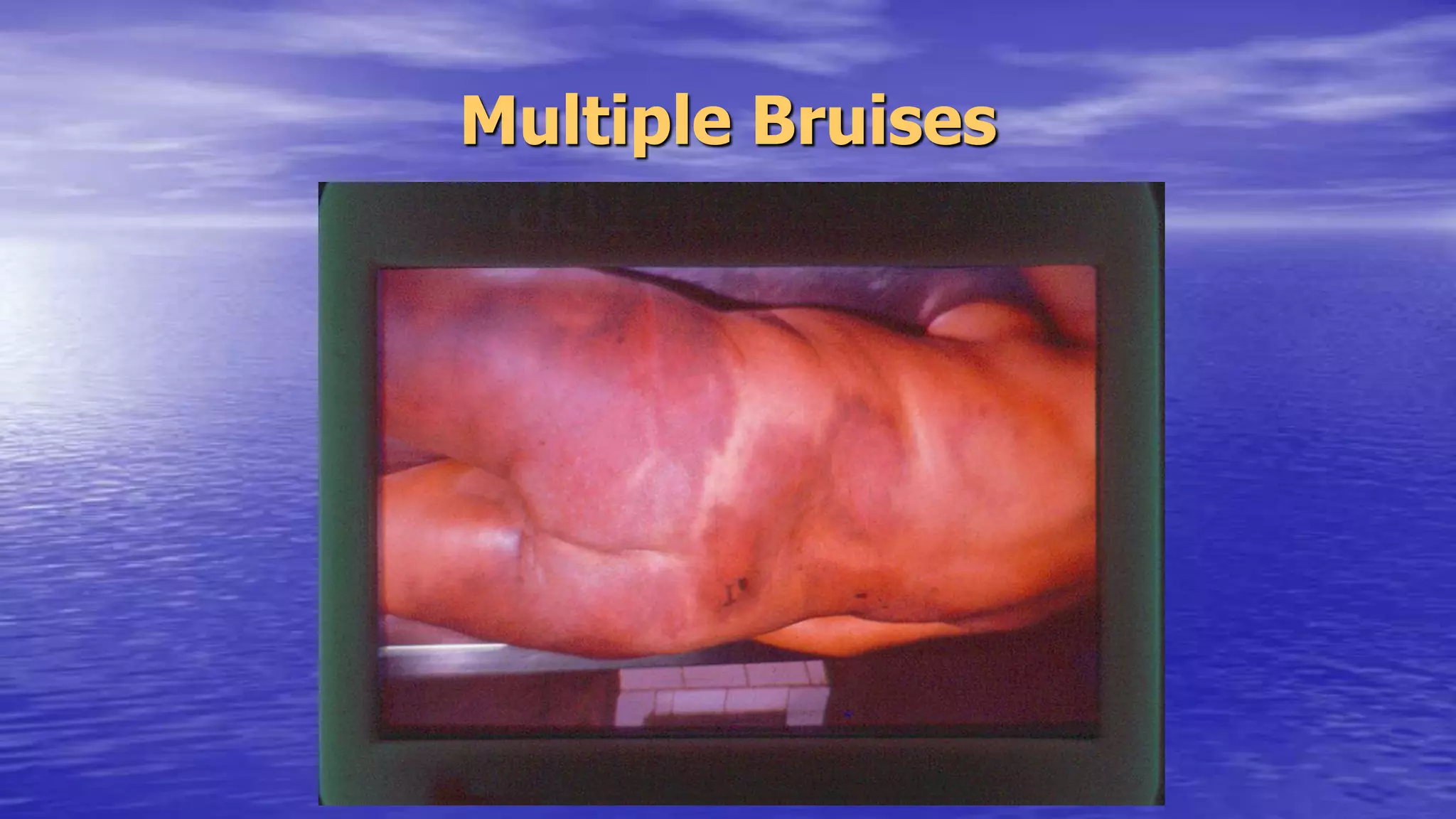 Multiple Bruises
 