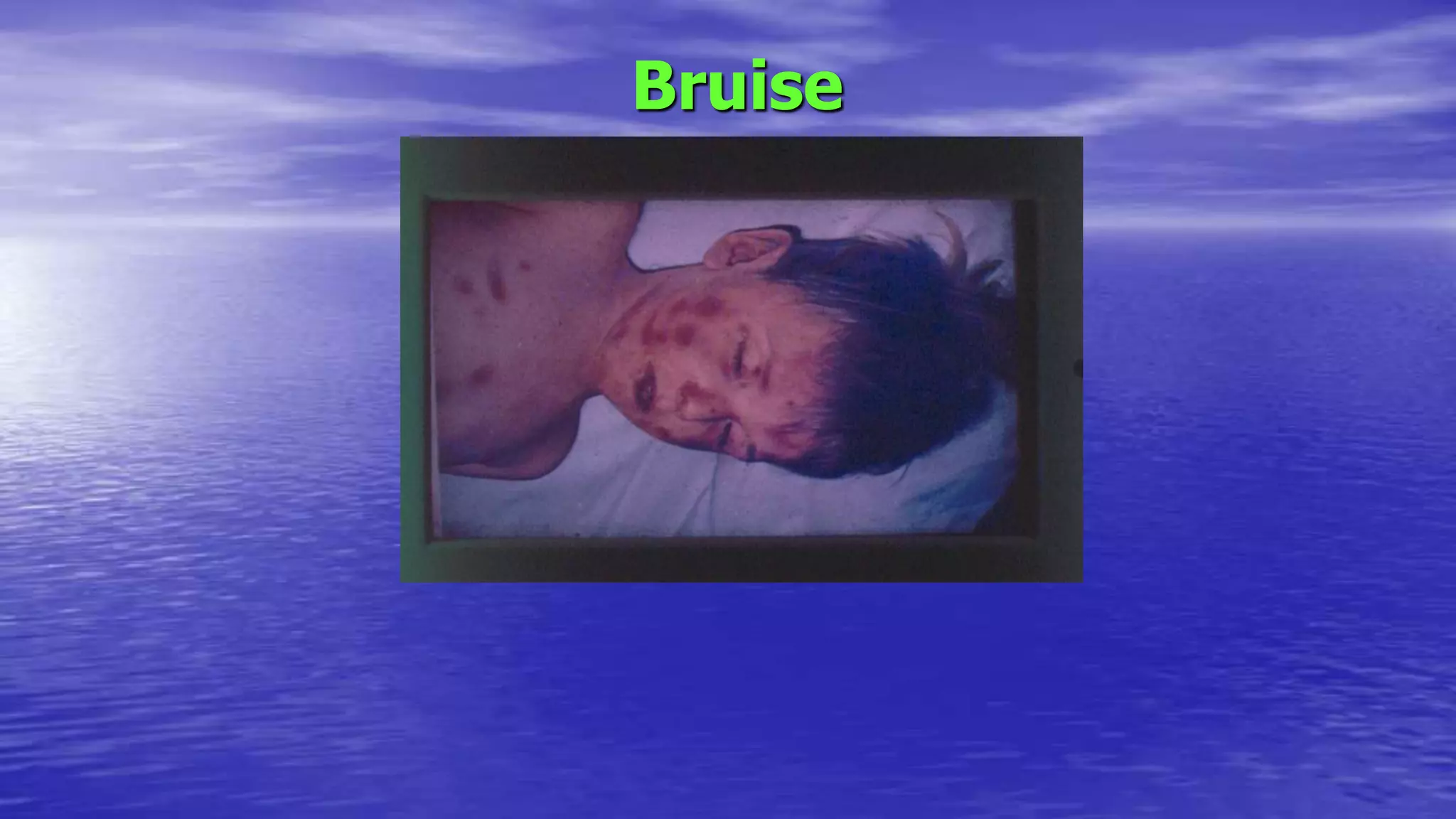 Bruise
 