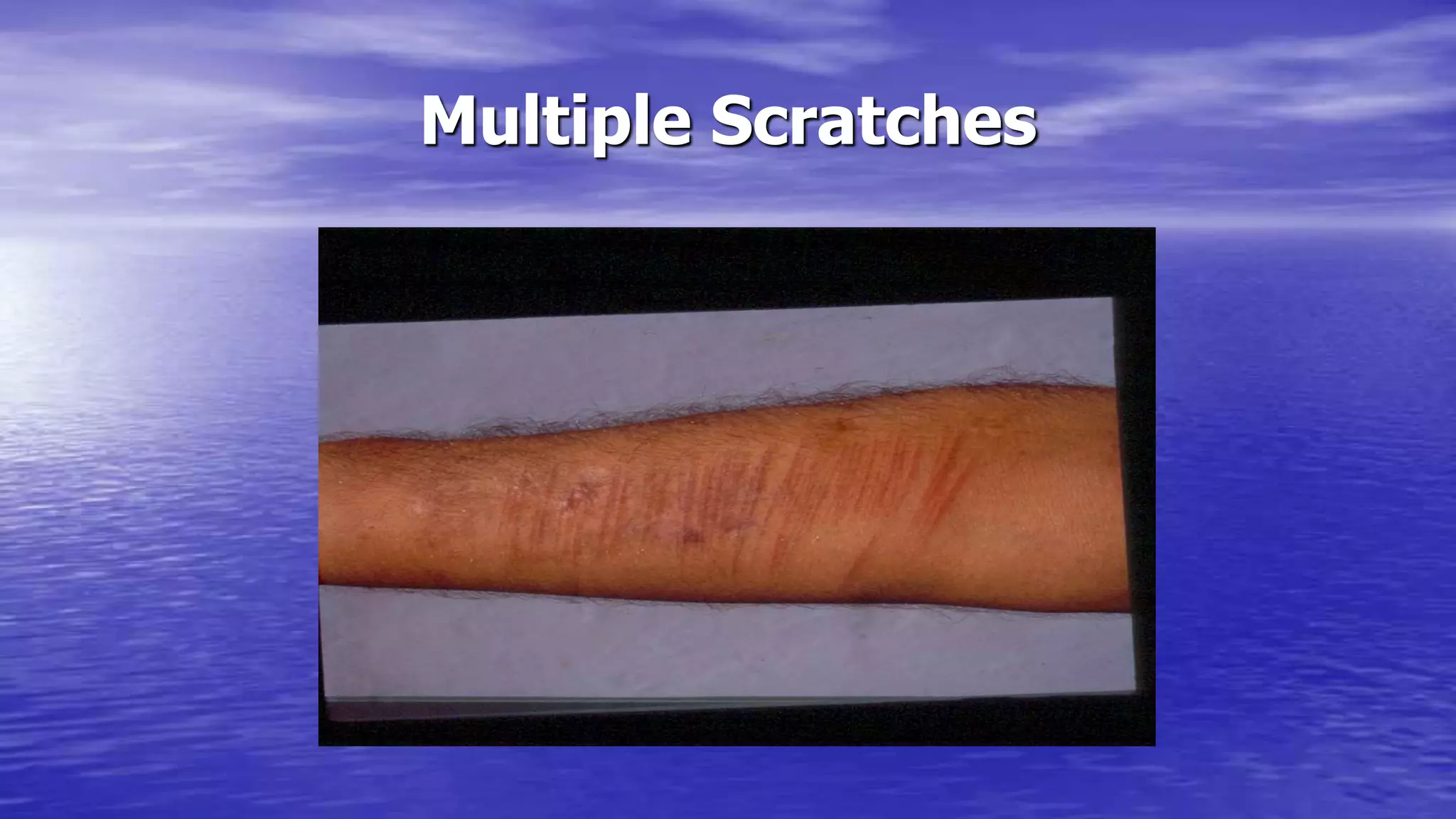 Multiple Scratches
 