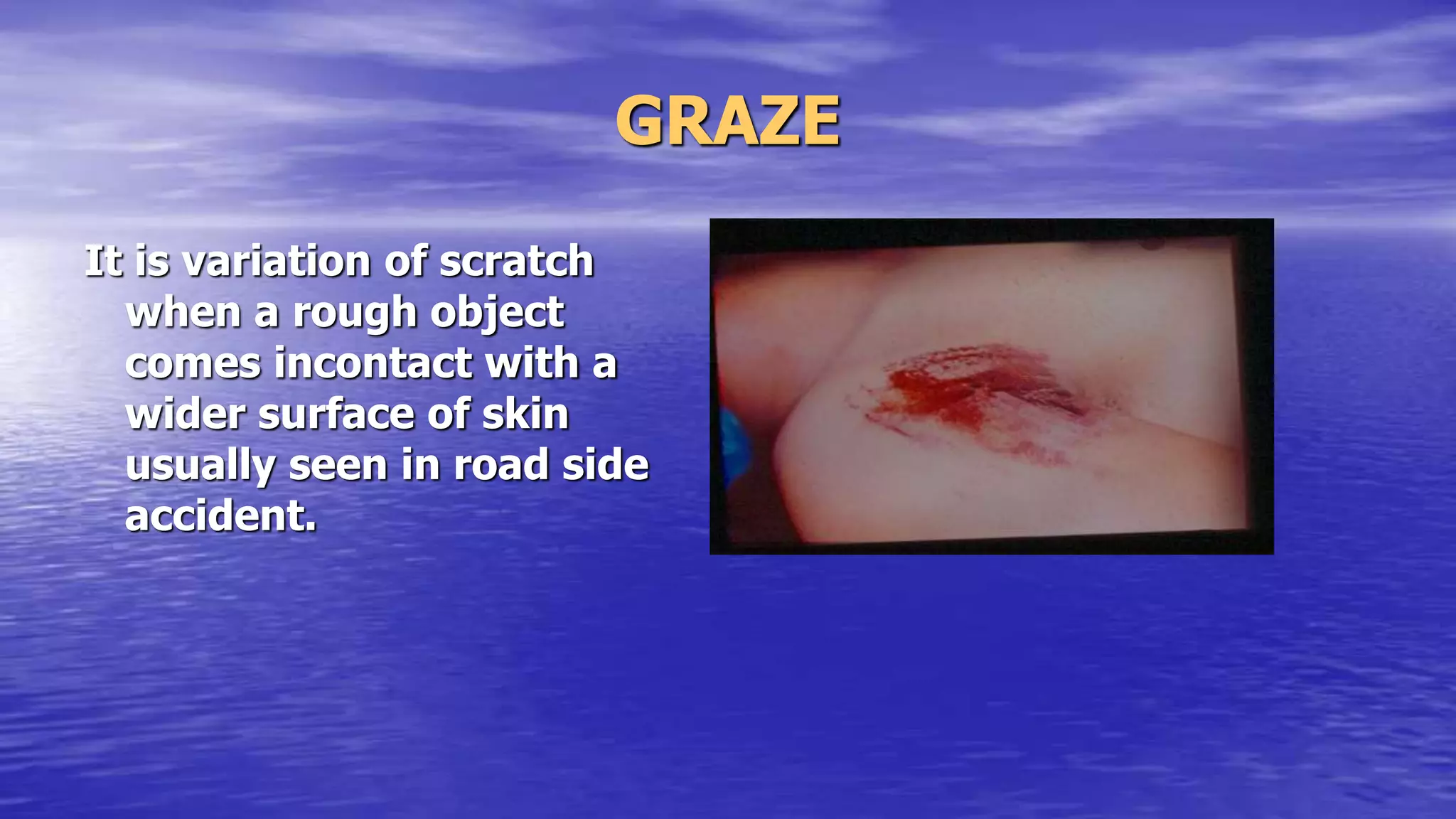 GRAZE
It is variation of scratch
when a rough object
comes incontact with a
wider surface of skin
usually seen in road side
accident.
 