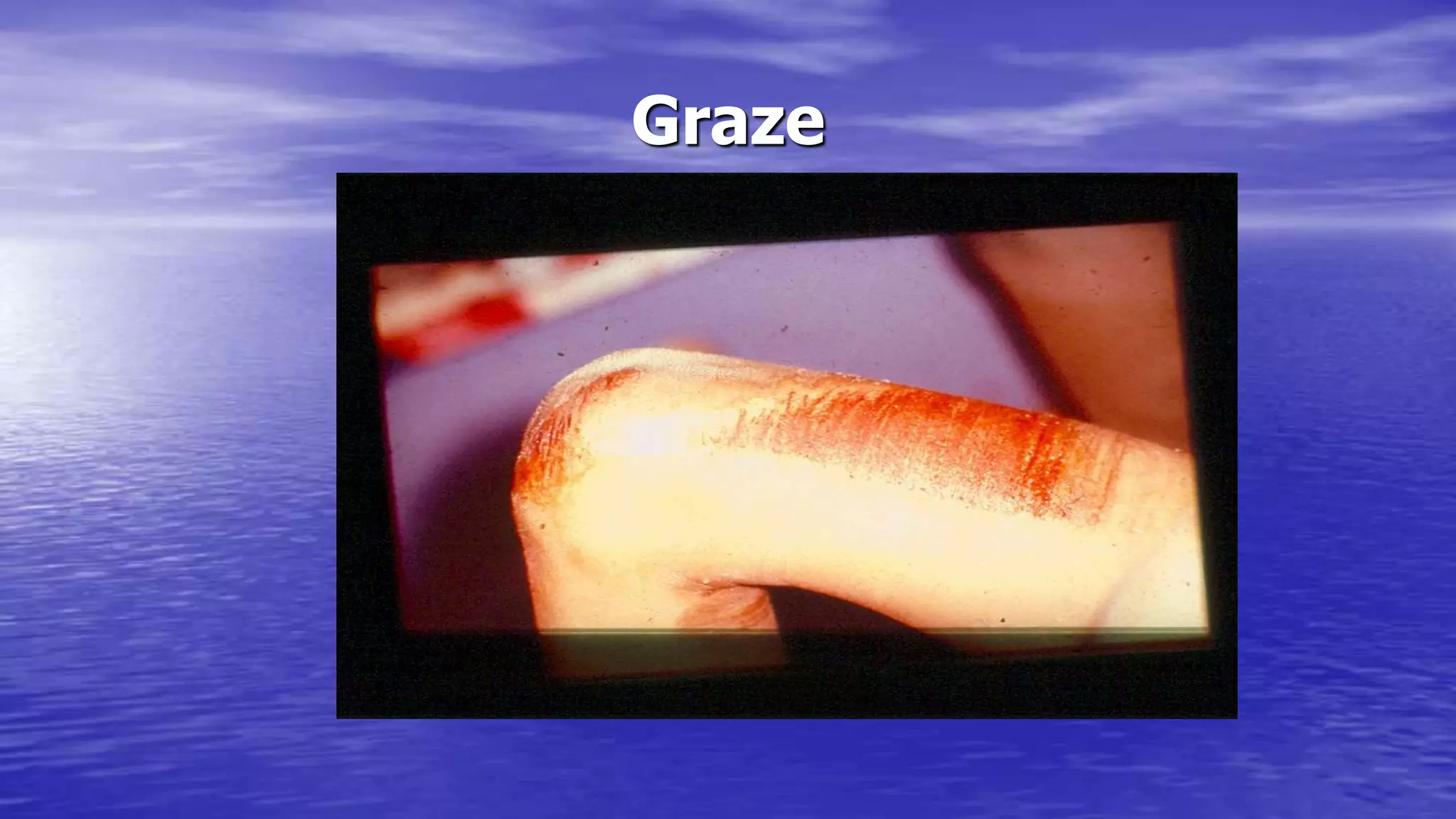 Graze
 