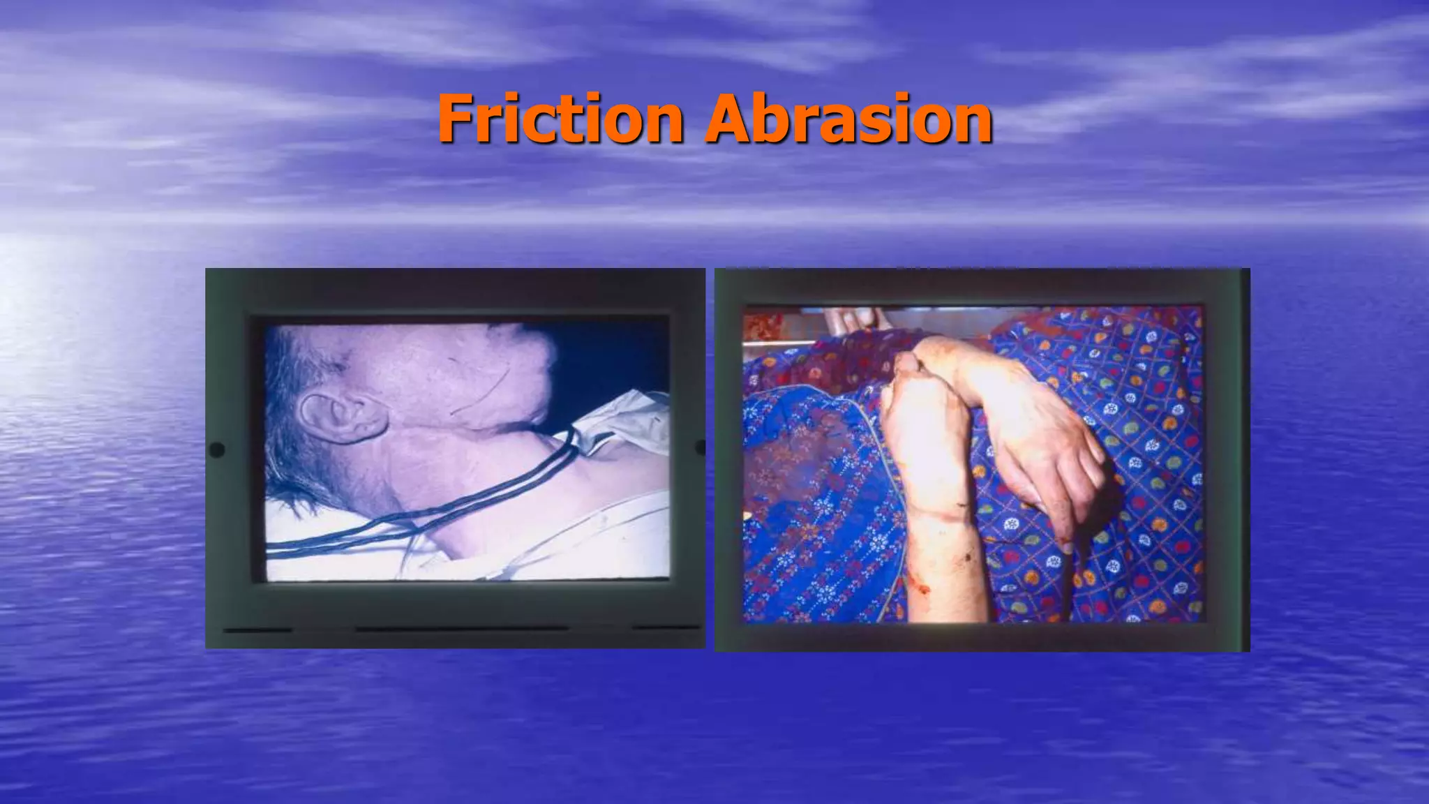Friction Abrasion
 