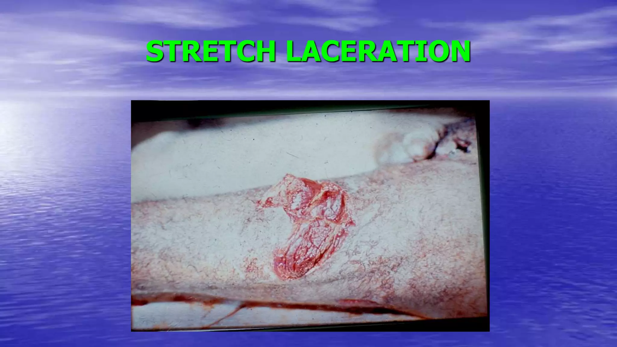 STRETCH LACERATION
 