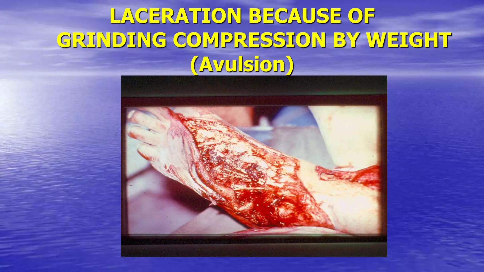 LACERATION BECAUSE OF
GRINDING COMPRESSION BY WEIGHT
(Avulsion)
 