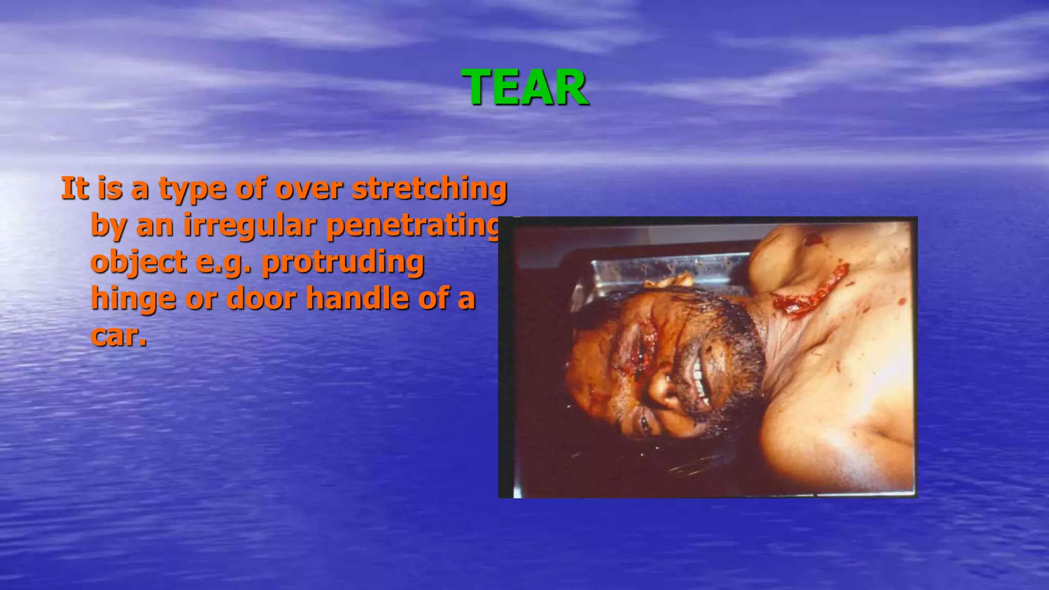 TEAR
It is a type of over stretching
by an irregular penetrating
object e.g. protruding
hinge or door handle of a
car.
 