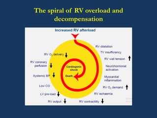 Preload Effected Rv Infarct Forgotten Ventricle | PPTX