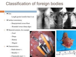 Foriegn body upper GI tract -role of endoscopy. | PPTX