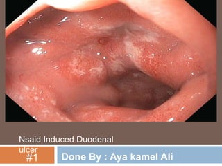 Nsaid Induced Duodenal
ulcer

#1

Done By : Aya kamel Ali

 
