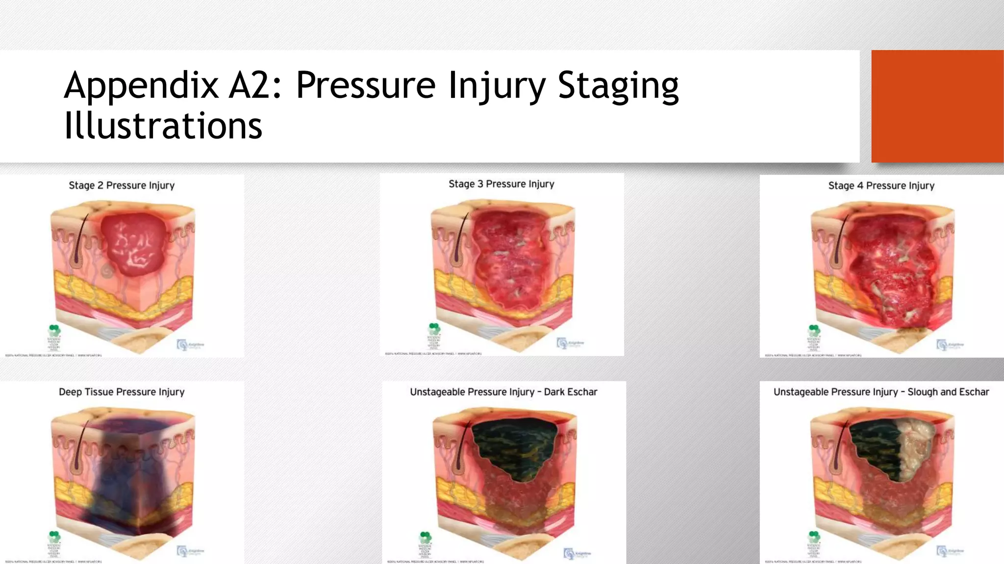 Formal Case Study: Pressure Ulcers | PPTX