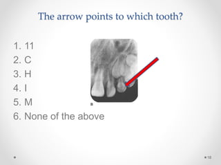 The arrow points to which tooth? 
18 
1. 11 
2. C 
3. H 
4. I 
5. M 
6. None of the above 
 