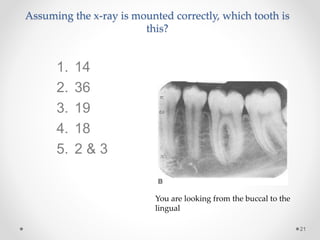 Assuming the x-ray is mounted correctly, which tooth is 
this? 
21 
You are looking from the buccal to the 
lingual 
1. 14 
2. 36 
3. 19 
4. 18 
5. 2 & 3 
 