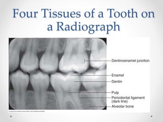 Four Tissues of a Tooth on 
a Radiograph 
 