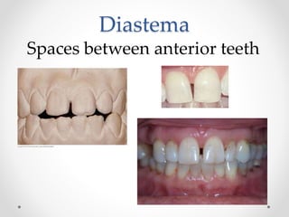 Diastema 
Spaces between anterior teeth 
 